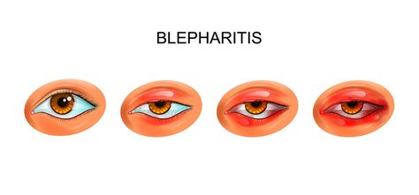 Bildergebnis für blepharitis ansteckend