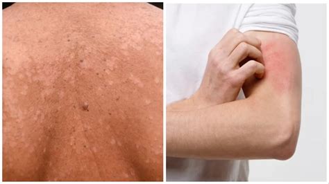 बारिश के मौसम में फैल रहा है टीनिया इंफेक्शन, जानें लक्षण और उपचार ...