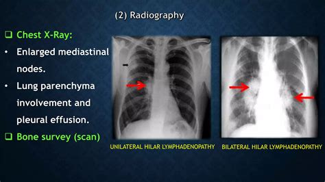 lymphadenopathy.pptx