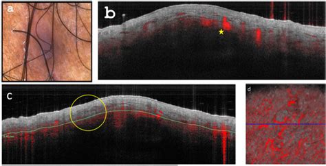Optical Coherence Tomography as a Valuable Tool for the Evaluation of ...