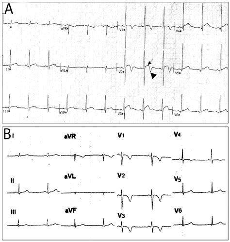 12-lead ECG in the athlete: physiological versus pathological ...