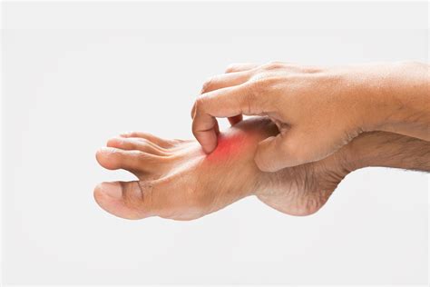 Picor en el empeine del pie: Causas y tratamiento