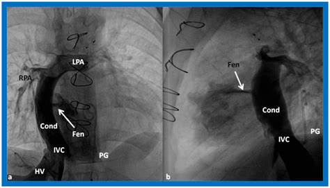 Double-Inlet Left Ventricle