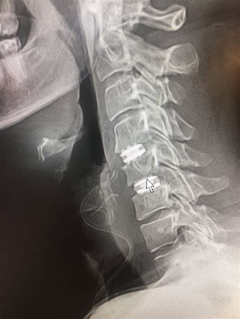 Cervical Artificial Disc Replacement (ADR) Vs. Anterior Cervical Discectomy And Fusion (ACDF ... - anterior cervical discectomy
