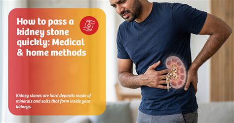 How to Pass a Kidney Stone Fast: Medical & Home Methods