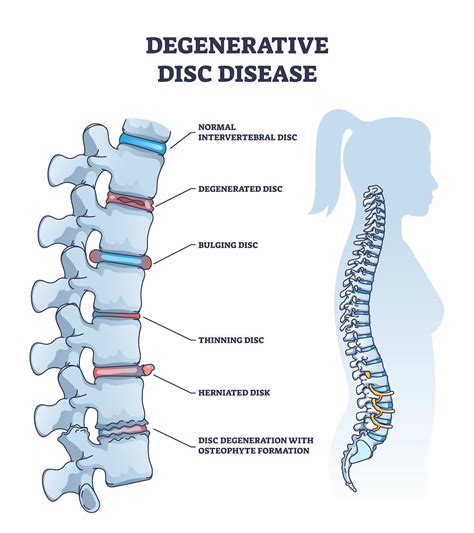 Managing Degenerative Disc Disease With Exercise
