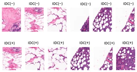 Intelligent Hybrid Deep Learning Model for Breast Cancer Detection