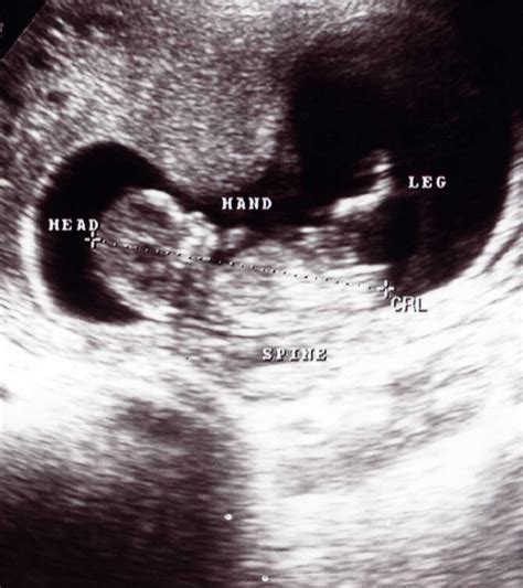 How To Measure Crown-Rump Length (CRL) In Pregnancy?