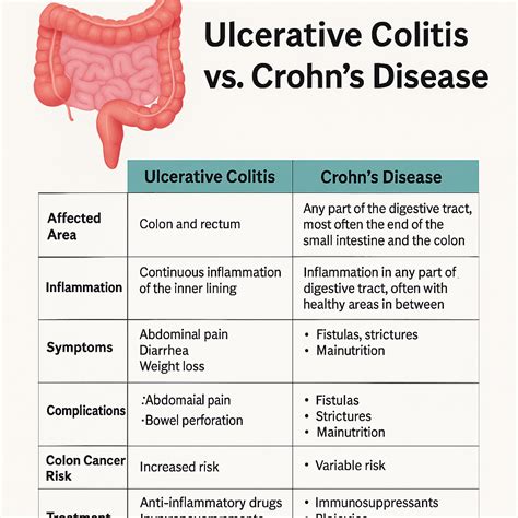 Ulcerative Colitis vs. Crohn’s Disease: Know the Difference