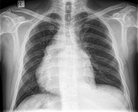 Mediastinal Position | Chest X-Ray - MedSchool