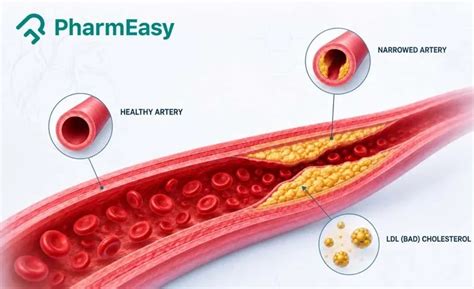 What Does High LDL Cholesterol Mean & How to Reduce It? | PharmEasy