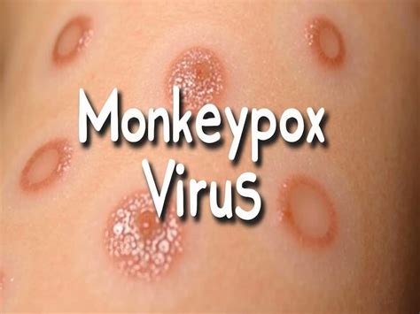 Mpox Update In India: Government Issues Detailed Guidelines Urging All ...