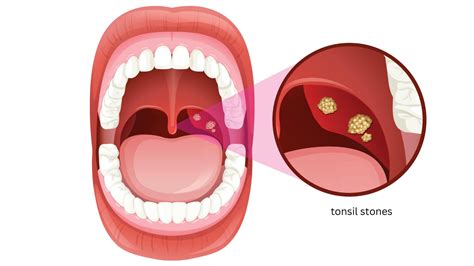 What Are Tonsil Stones Made Of? Understanding Their Composition & Treatment