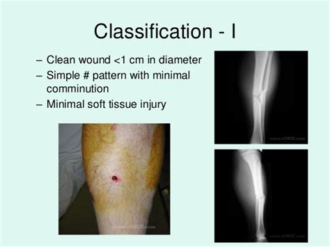 Image result for Open Fracture Surgery