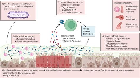 Early-life respiratory syncytial virus disease and long-term respiratory health - The Lancet ...