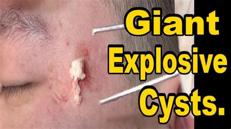 Image result for Big Cysts Exploding