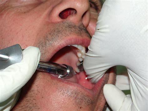 Surface Anesthesia 的图像结果