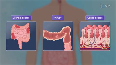 Video: Endoscopic Procedures III: Video Capsule Endoscopy