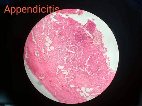 Acute appendicitis: Pathogenesis, Morphology, Complications-NotesMed >