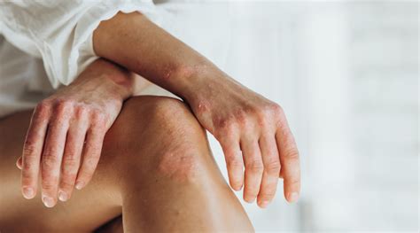 सोरायसिस के प्रकार, लक्षण और कारण - HealthKart