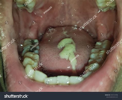 Mucus In Throat