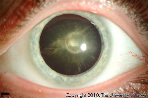 Posterior Polar Cataract. EyeRounds.org - Ophthalmology - The ...
