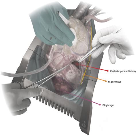 Posterior pericardial window: a simple and reproducible technique in order to prevent ...