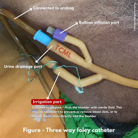 3 way and 2 way foley catheter - TCML Flux