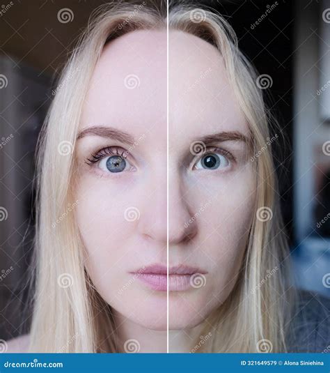 Before and after Eye Drops To Examine the Fundus, Pupil Dilation. a ...