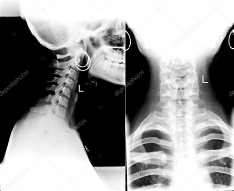 Image result for Neck X-Ray