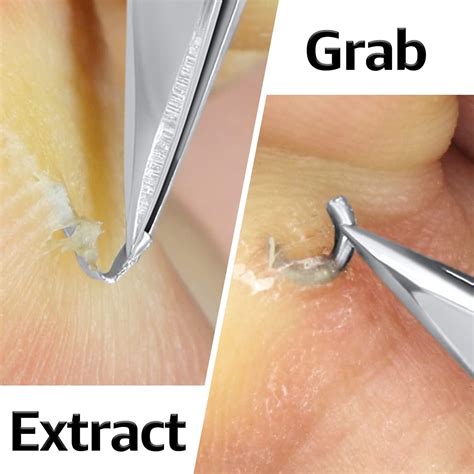 Image result for Remove Splinter