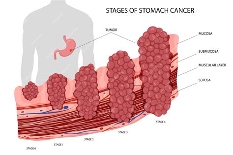 Stomach Cancer Stages