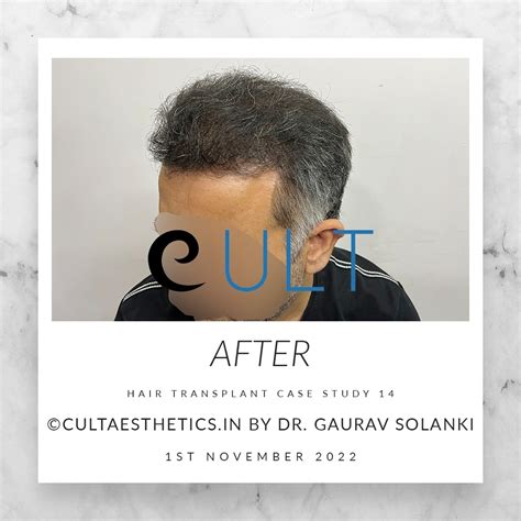 Hair Transplant Results 14Cult Aesthetics