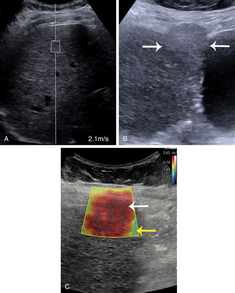 Focal liver lesions in the setting of chronic liver disease | Radiology Key