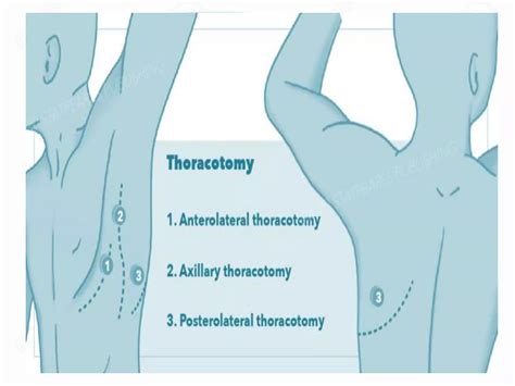 Image result for Thoracotomy Approach