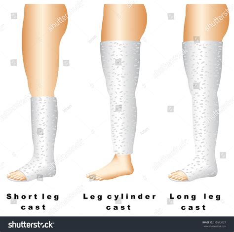 Leg Casts. Long Leg Casts Are Applied From The Upper Thigh To The Foot ...