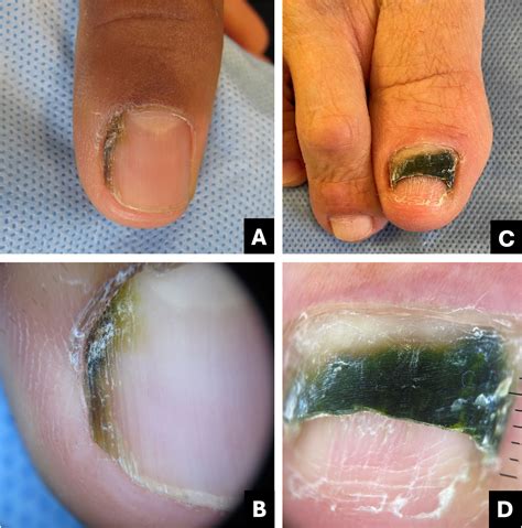 Differential diagnosis of pigmented nail lesions | Anais Brasileiros de Dermatologia (Portuguese)