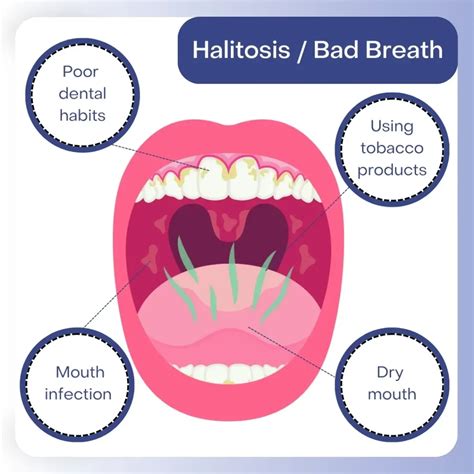 Preventing Bad Breath: Causes and Effective Remedies | F Dental Center 2026