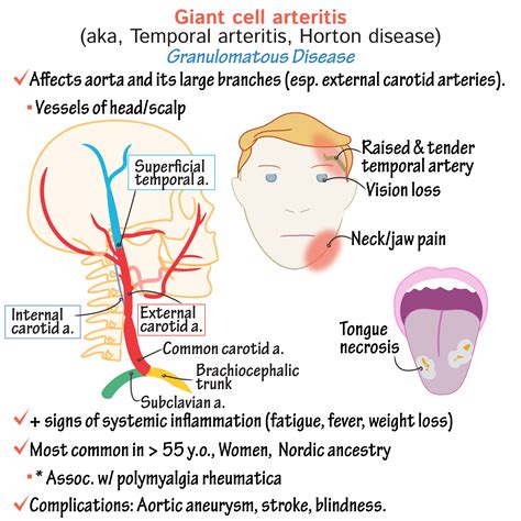 Clinical Pathology Glossary: Giant Cell Arteritis | ditki medical & biological sciences