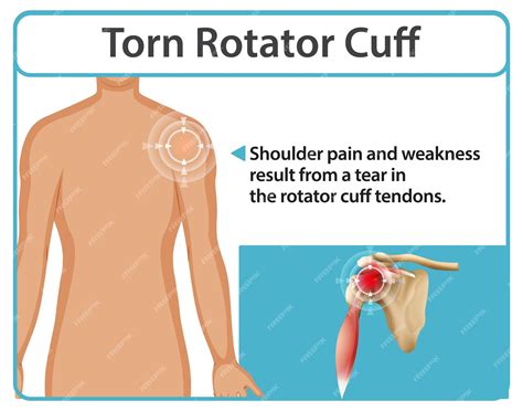 Free Vector | Understanding Torn Rotator Cuff Injuries