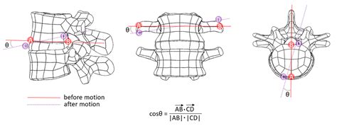 Assessment of Spinal Stability after Discectomy Followed by Annulus ...