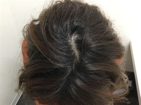 女性の薄毛の患者様（47歳 ルートヴィッヒ分類Ⅱ） | 駅前AGAクリニック【新宿、北千住、大阪、京都、岡山、鹿児島など】