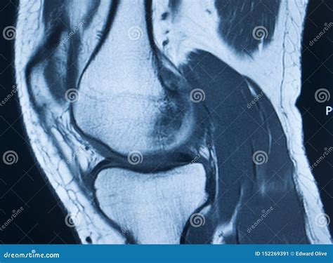 Knee injury mri mcl tear stock image. Image of bone - 152269391