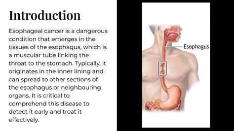 Esophageal Cancer Causes, Symptoms, Diagnosis, and Treatment | PPT