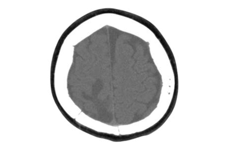 Image result for Transnasal Loop Fixation
