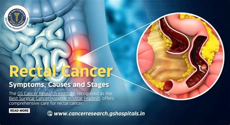 Rectal Cancer: Symptoms, Causes and Stages