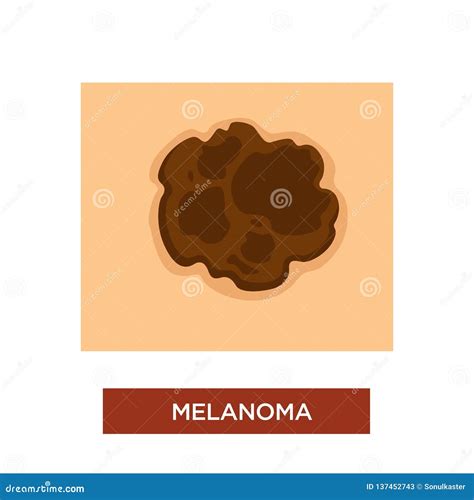 Melanoma or Skin Cancer Disease Dangerous Mole Stock Vector - Illustration of anatomy ...