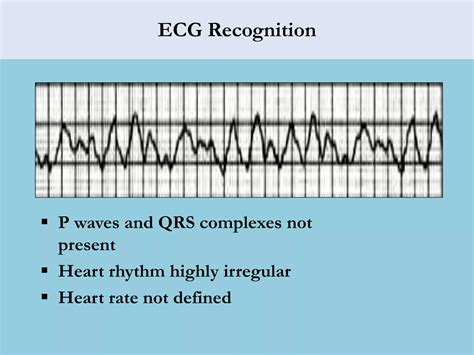 Lec 9 narrow complex wide complex tachycardia for mohs | PPTX | Heart and Cardiovascular ...