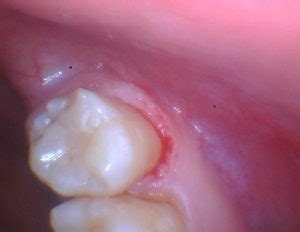 Image result for Wisdom Tooth Decayed