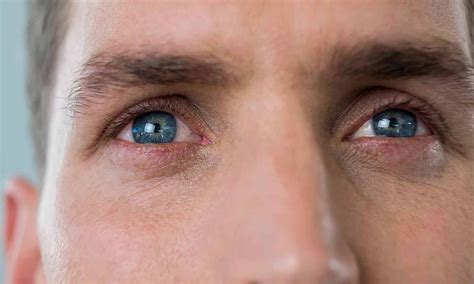 Strabismus | Lasik Türkei 👁️